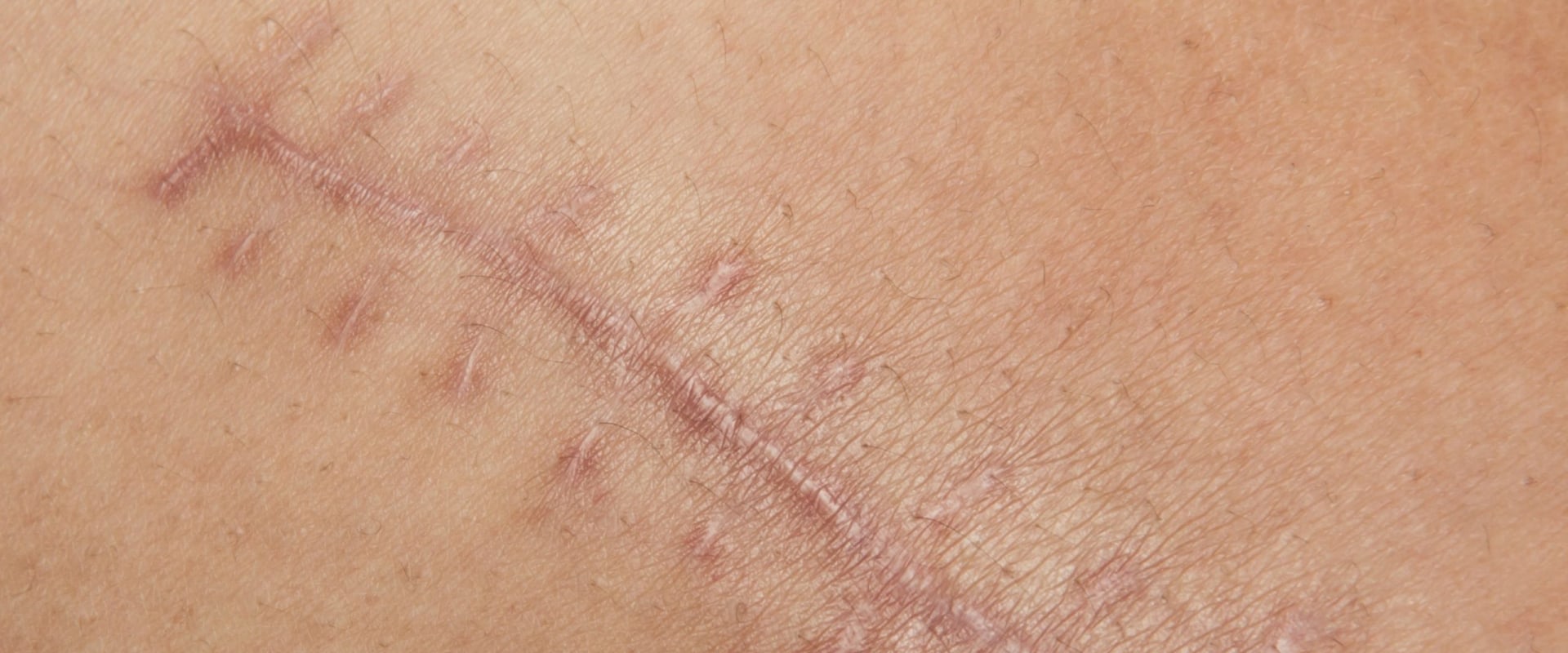Phases of Wound Healing That Affect Speed, Scarring, and Recovery