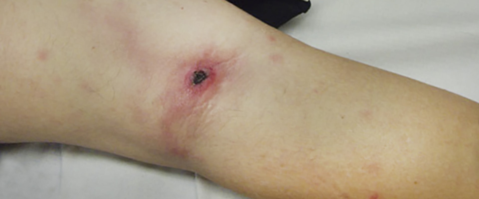 Understanding Eschar Skin: Causes, Symptoms, and Treatment