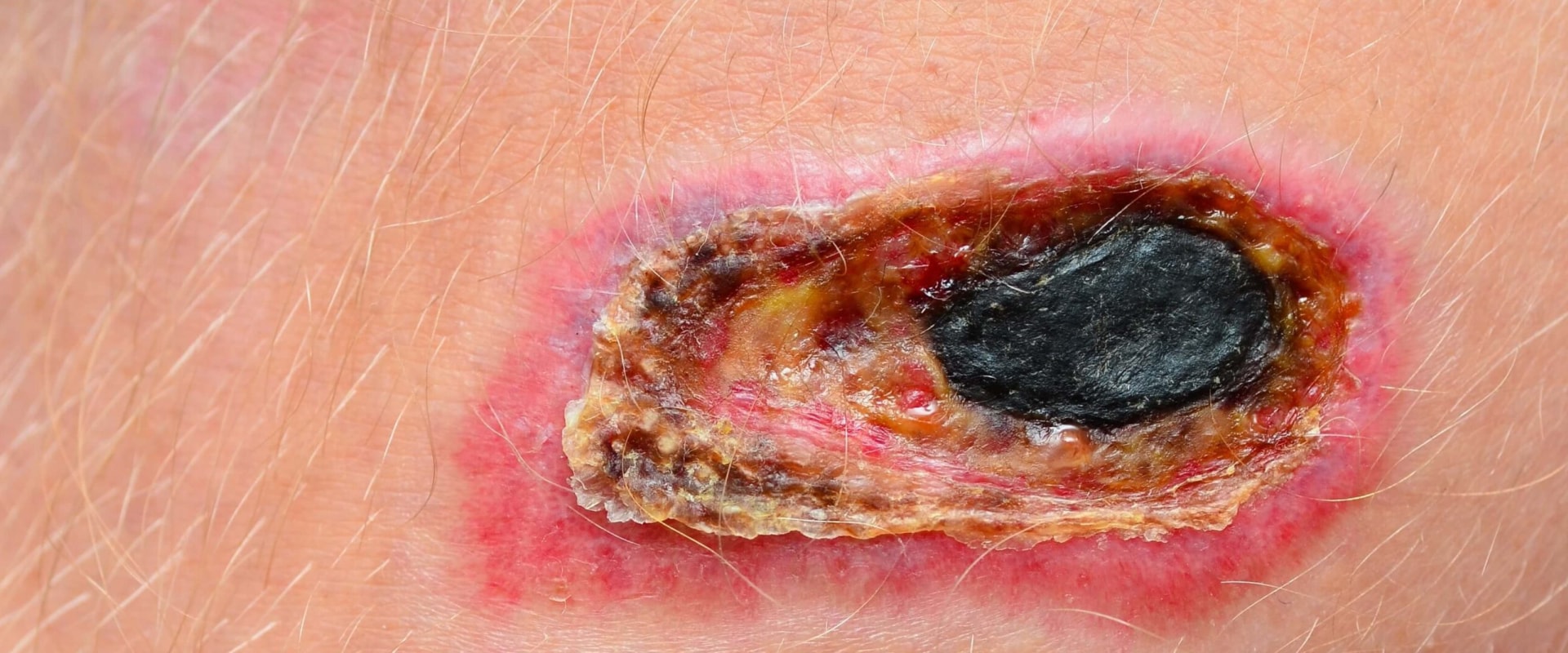The Importance of Debridement for Healing Necrotic Wounds