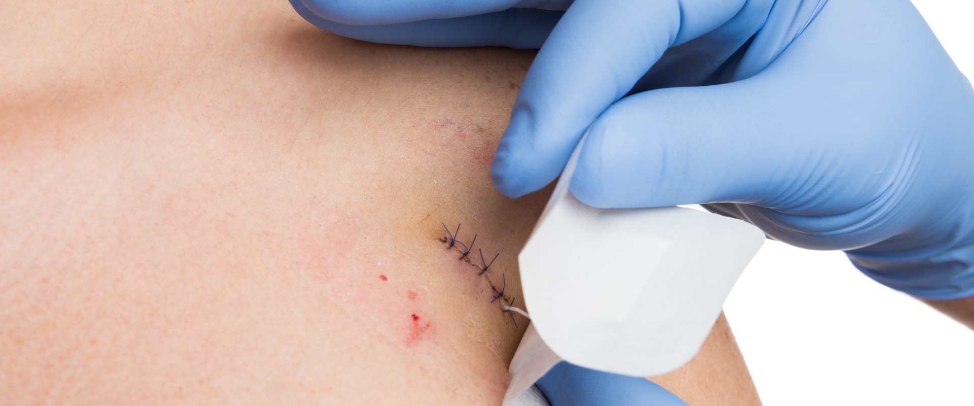 Dissolvable Stitches Healing Stages: Recover Faster & Better