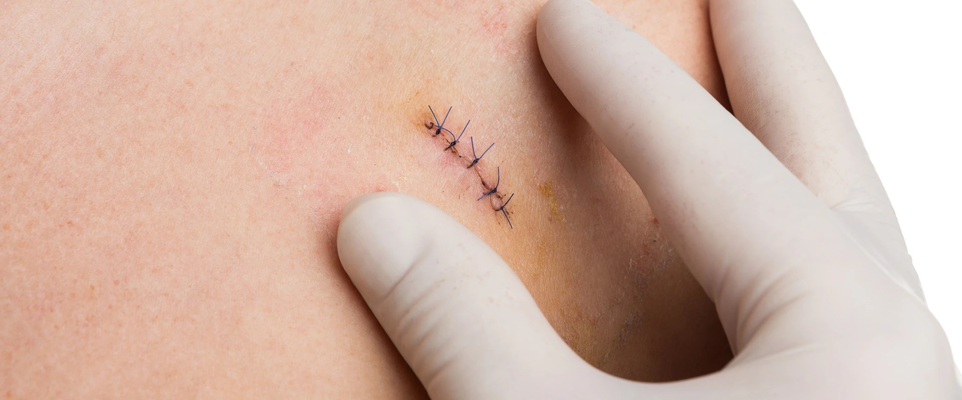 How Long Do Stitches Take to Heal After Surgery Learn the Facts About Recovery Time, Key Factors That Affect Healing