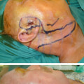 The Devastating Effects of Necrosis: Causes, Treatment, and Recovery
