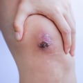 The Role of Eschar in Wound Healing