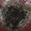 Expert Tips for Treating and Removing Eschar: A Wound Care Specialist's Perspective