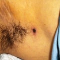 Understanding Eschar: A Wound Care Specialist's Perspective