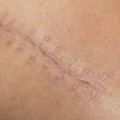 Phases of Wound Healing That Affect Speed, Scarring, and Recovery