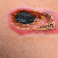 The Importance of Identifying Necrotic Wounds: An Expert's Perspective