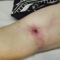 The Importance of Understanding Eschar in Wound Healing: A Wound Care Expert's Perspective