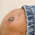 The Importance of Scabs and Sores in the Wound Healing Process