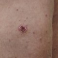 The Importance of Early Detection and Treatment of Eschar