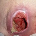 Understanding the Depth and Treatment of Stage 4 Pressure Ulcers