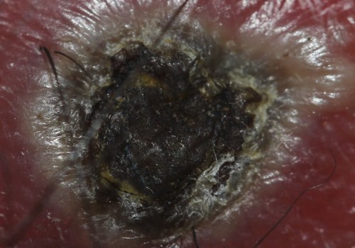 The Importance of Proper Wound Care: Understanding the Role of Black Eschar
