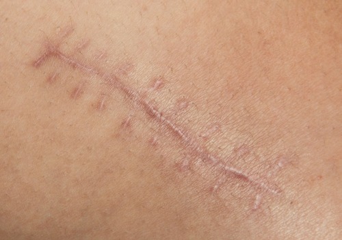 Phases of Wound Healing That Affect Speed, Scarring, and Recovery