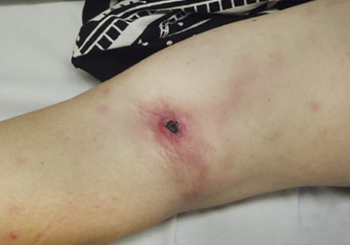 The Importance of Understanding Eschar in Wound Healing: A Wound Care Expert's Perspective