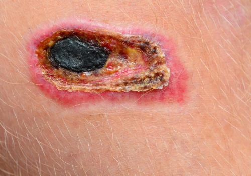 The Importance of Debridement for Healing Necrotic Wounds