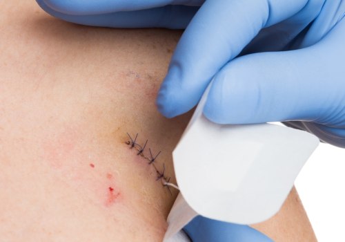 Dissolvable Stitches Healing Stages: Recover Faster & Better