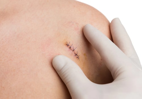 How Long Do Stitches Take to Heal After Surgery Learn the Facts About Recovery Time, Key Factors That Affect Healing